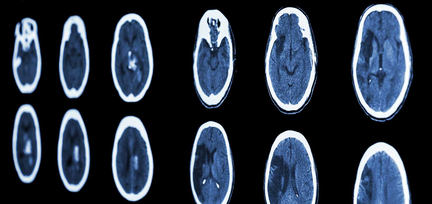 Blunt Force Trauma to The Head Golden State Lawyers, APC